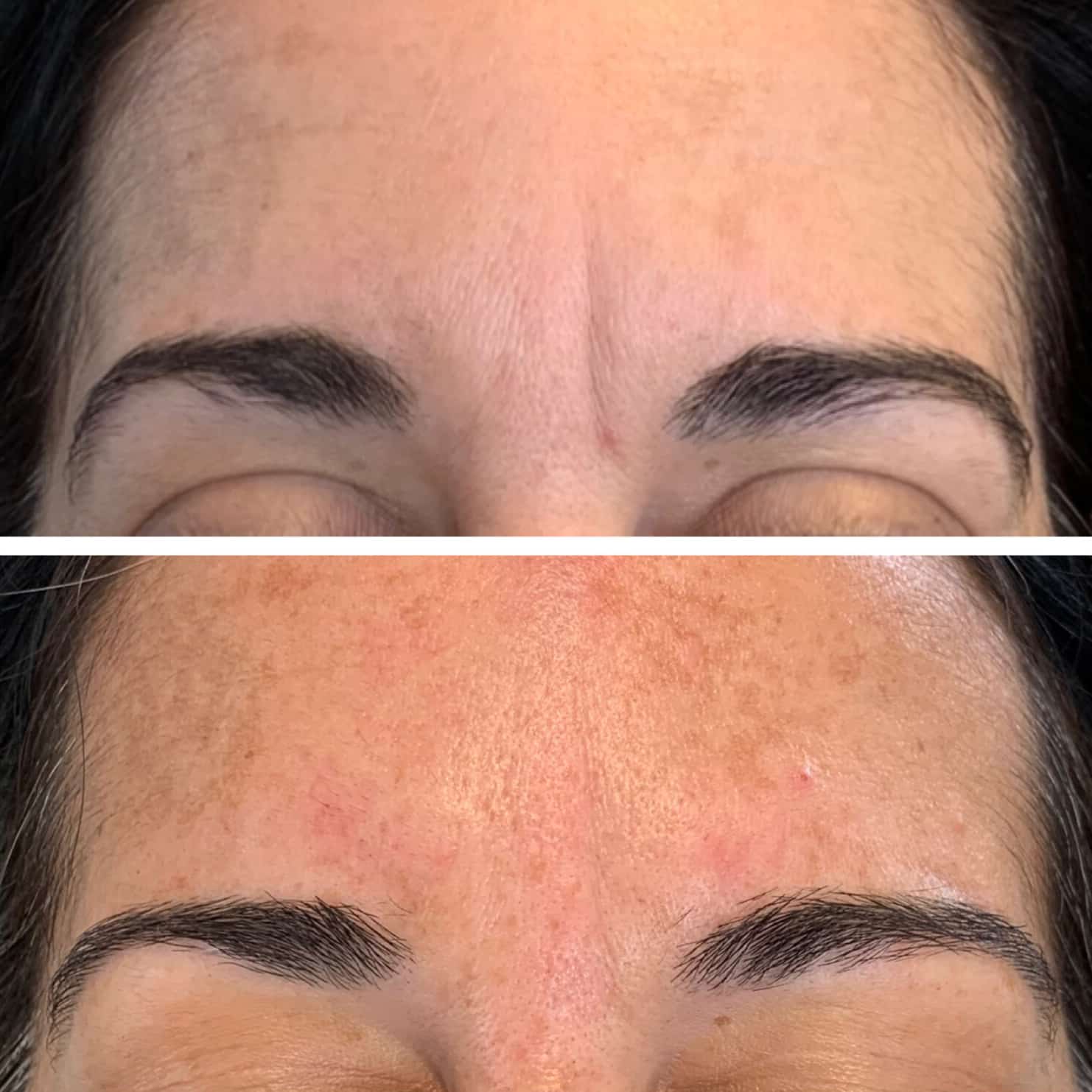 Woman's forehead showing improved tightened skin as a result of PDO threads.
