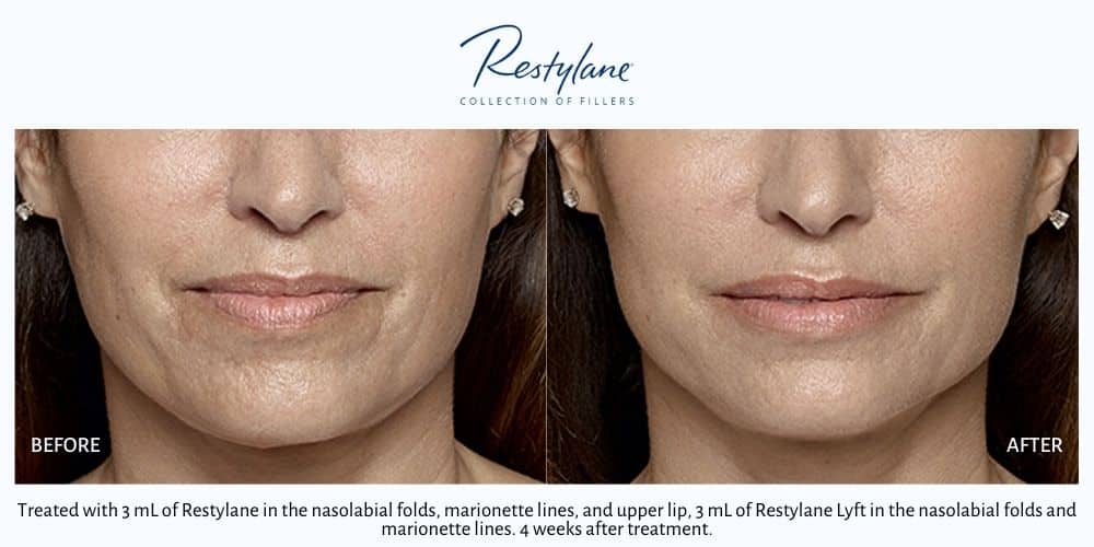 Woman's mouth showing wrinkles and dimpling around the mouth before and smoother, plumper skin after Restylane dermal filler treatment in Las Vegas and Reno.