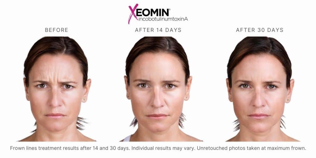 Woman's xeomin before and after results.