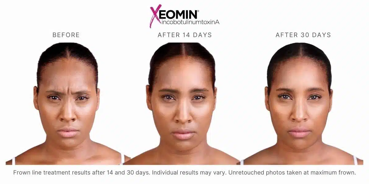 Woman's xeomin before and after results.