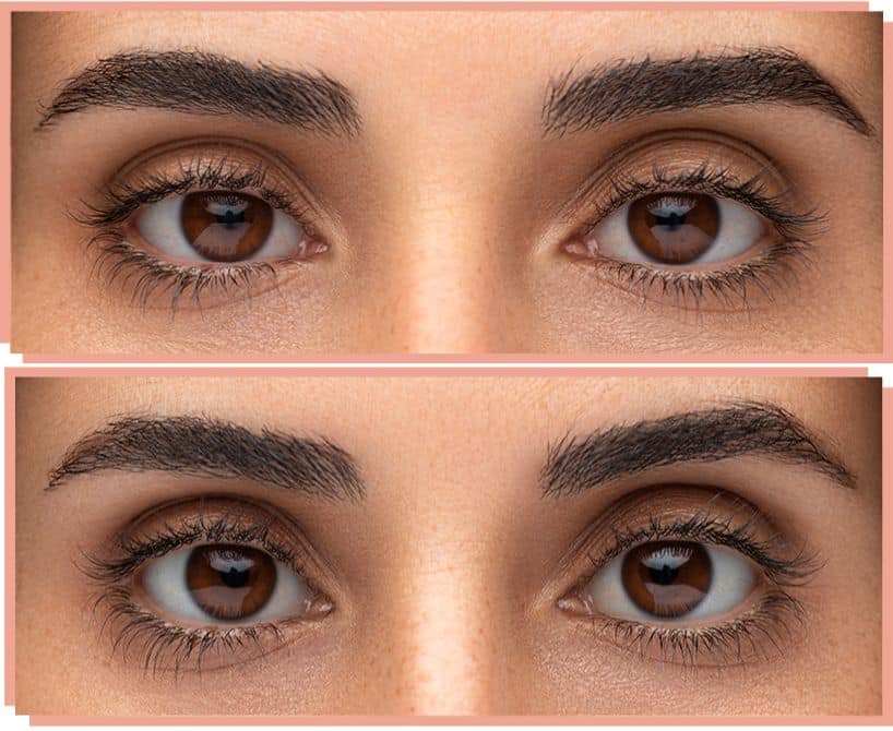 Woman's droopy eyes before and after upneeq treatment.