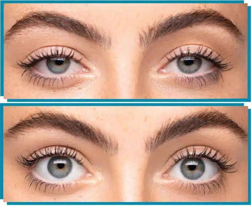 Woman's droopy eyes before and after upneeq treatment.