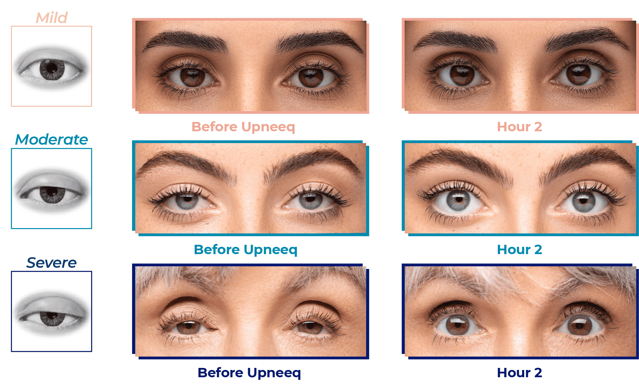 Before and after Upneeq results.