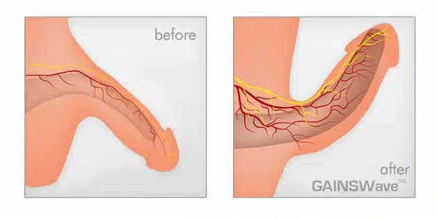 Gainswave Sexual Wellness