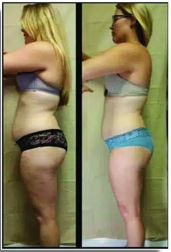 Before and after weight loss.