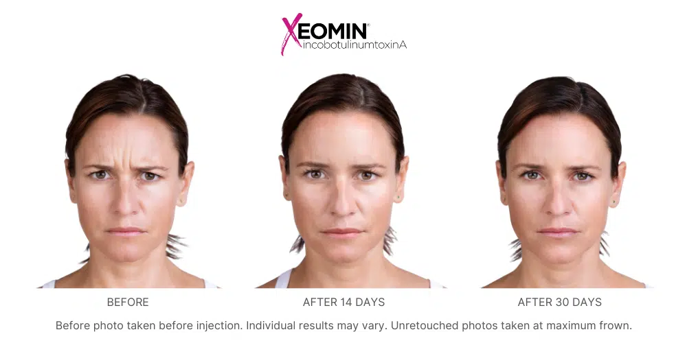Before and after images showing a woman's face with wrinkles on the forehead before Xeomin treatment and smooth, wrinkleless skin 14 and 30 days after treatment.