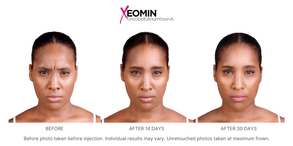 Before and after images showing a woman with furrowed, wrinkled skin between her brows before Xeomin treatment at Revenge MD and smoother, less wrinkled skin 14 and 30 days after treatment.