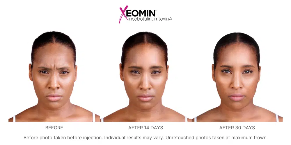 Before and after images showing a woman with furrowed, wrinkled skin between her brows before Xeomin treatment at Revenge MD and smoother, less wrinkled skin 14 and 30 days after treatment.