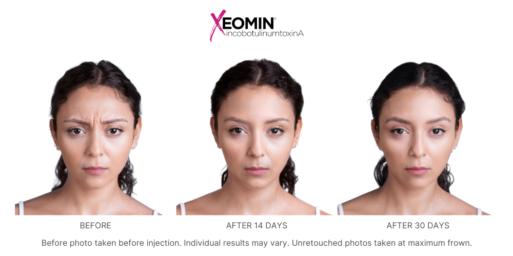 Before and after images showing a woman with wrinkles between her eyebrows before and smooth, wrinkle-free skin after Xeomin treatment at Revenge MD.