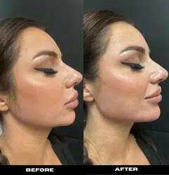 Real Revenge MD patient showing fuller, plumper lips with fewer lines around the mouth after dermal filler treatment.