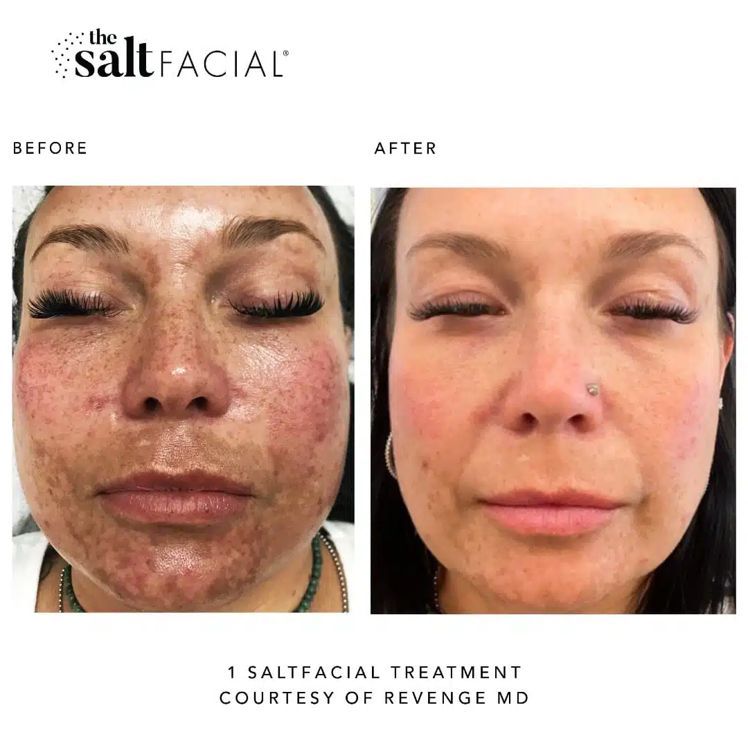 Woman's before and after results from salt facial treatment at Revenge MD.