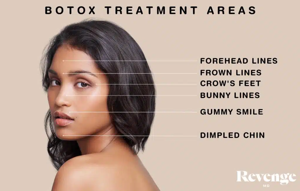A diagram showing the treatment areas for Botox treatment, a service offered at Revenge MD in Las Vegas and Reno, NV.