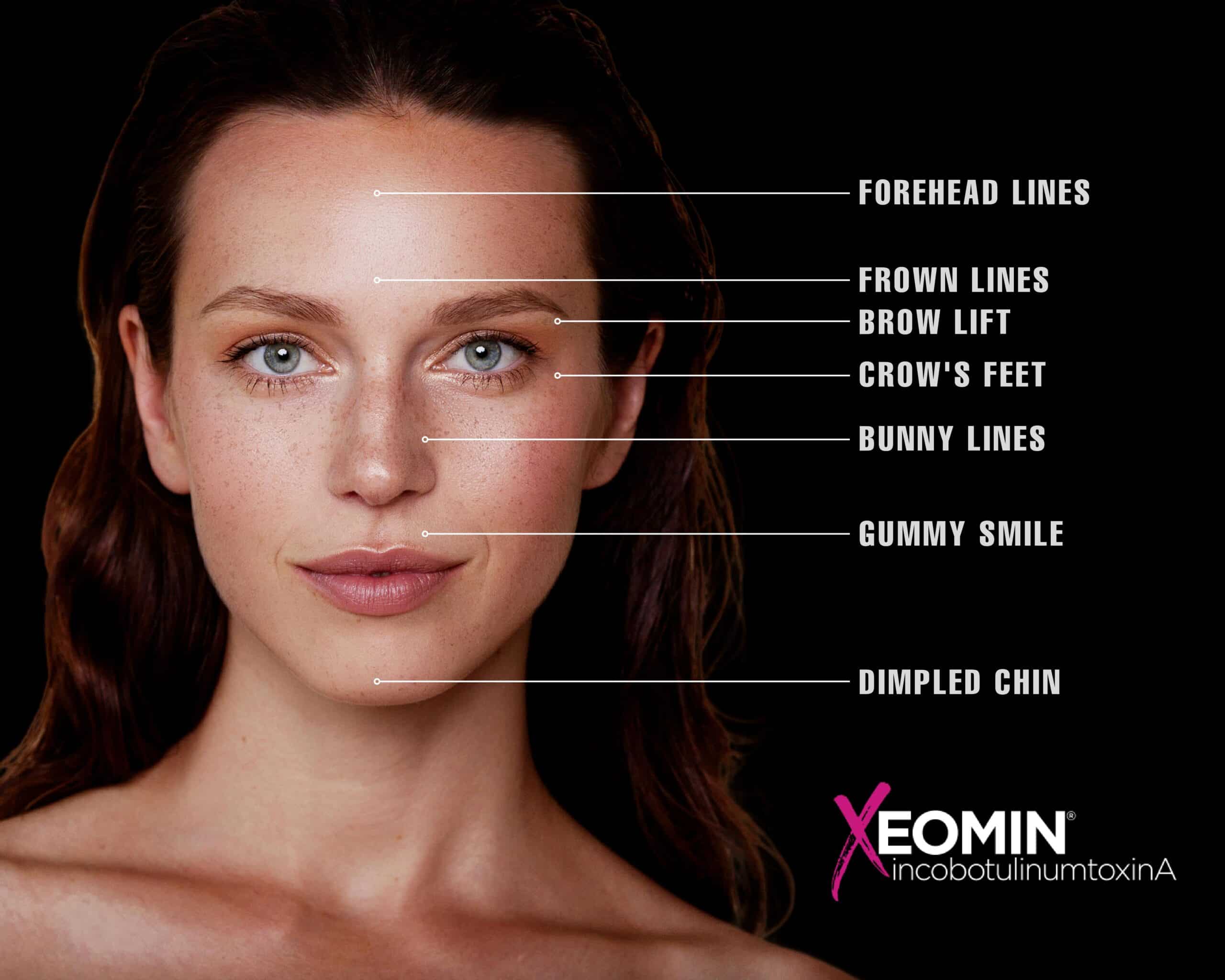 Beautiful woman with radiant, smooth skin models Xeomin treatment areas in Las Vegas and Reno.