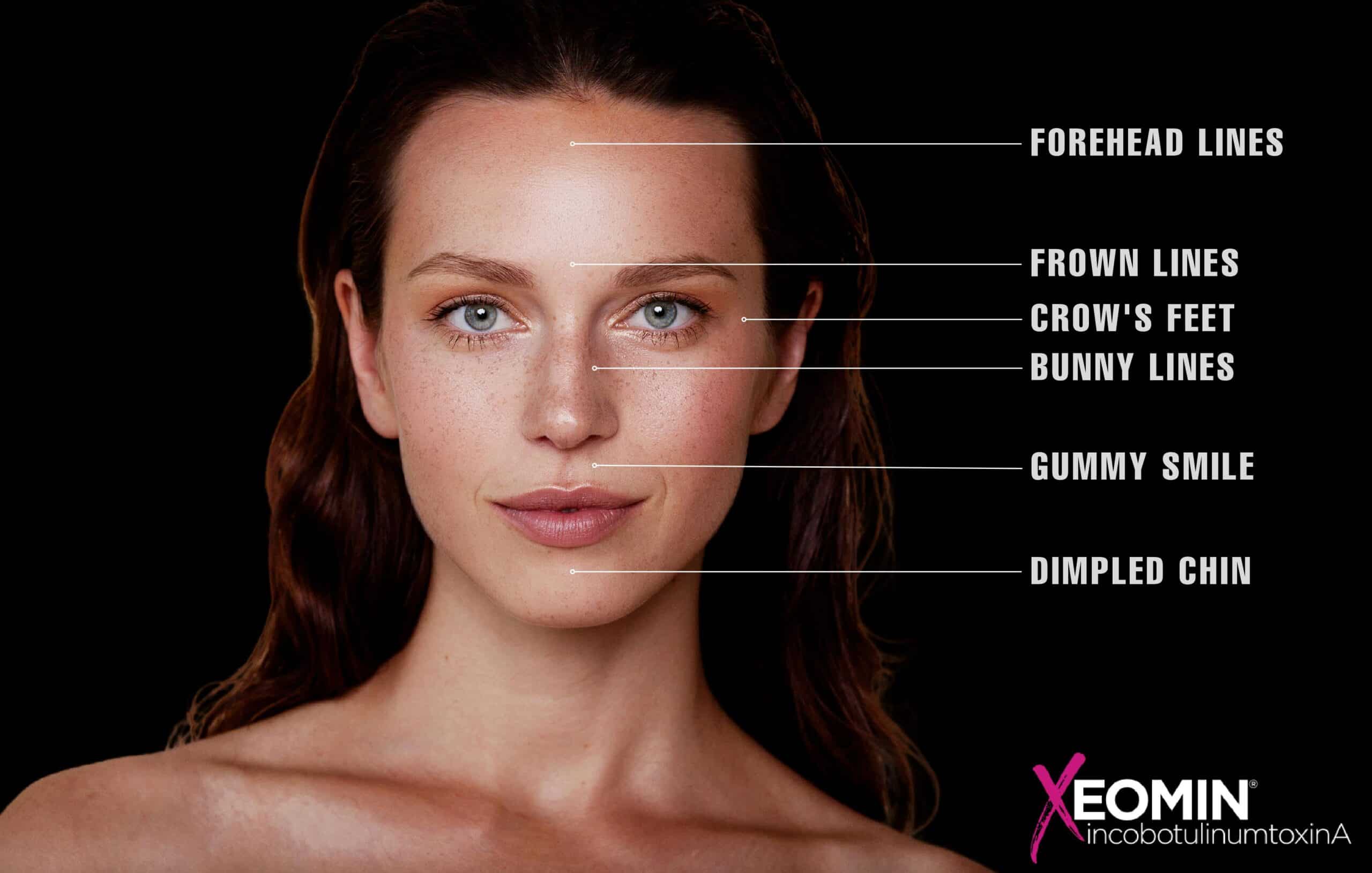 Beautiful woman with radiant, smooth skin models Xeomin treatment areas in Las Vegas and Reno.