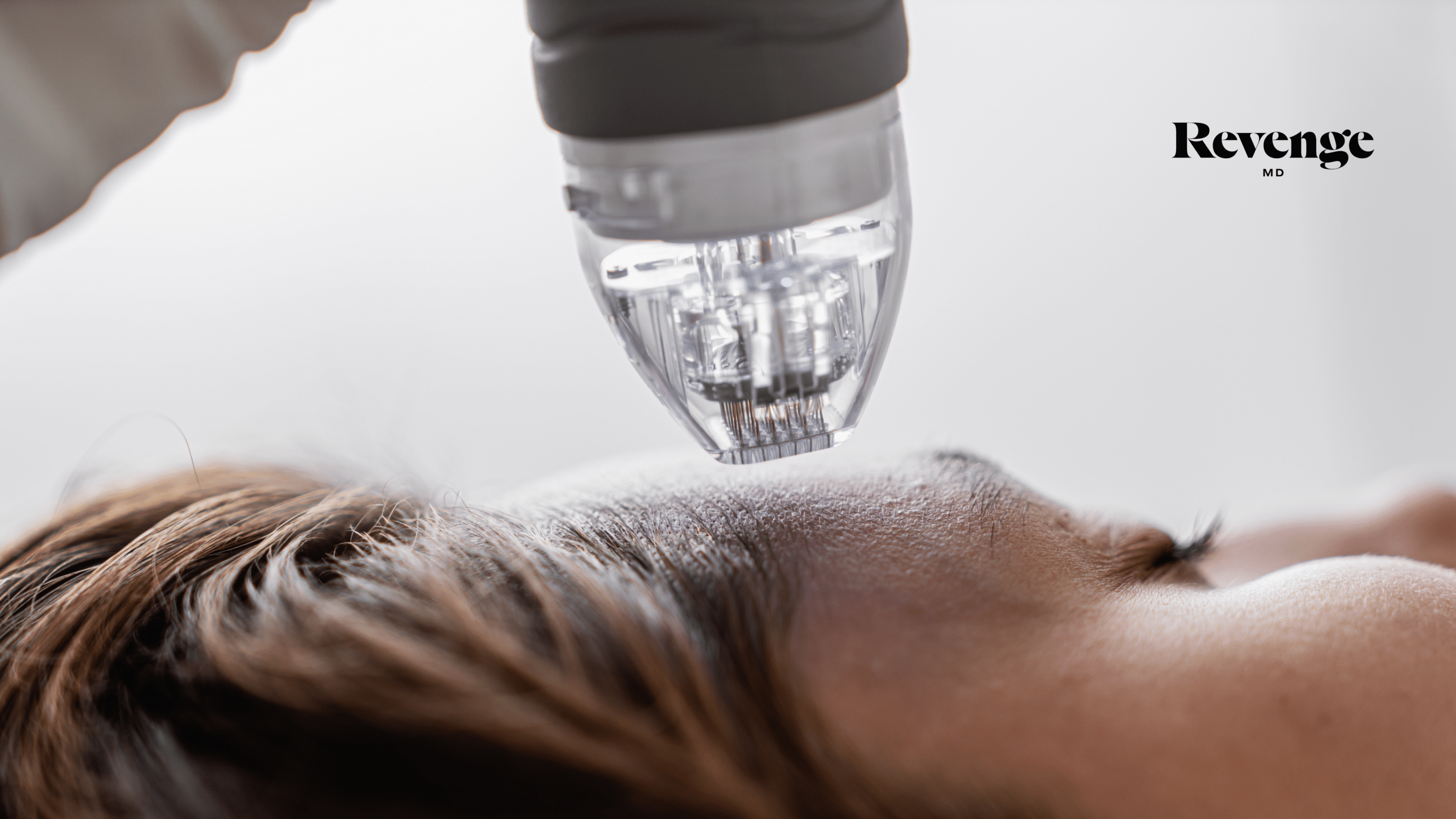 Microneedling 2
