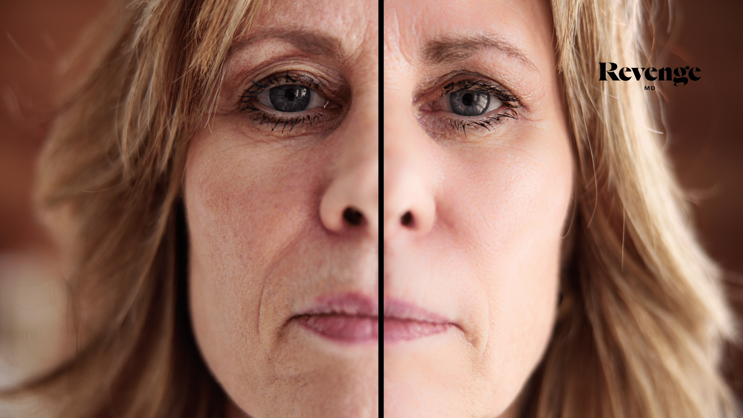 Microneedling 3