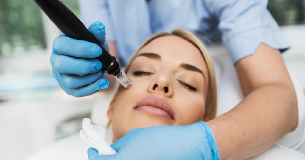 A women Receiving Microneedling in  Las Vegas, NV