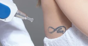 Laser Tattoo Removal IN LAS VEGAS, NV