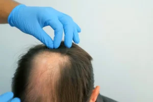 Hair Transplant Options for Men and Women in Las Vegas