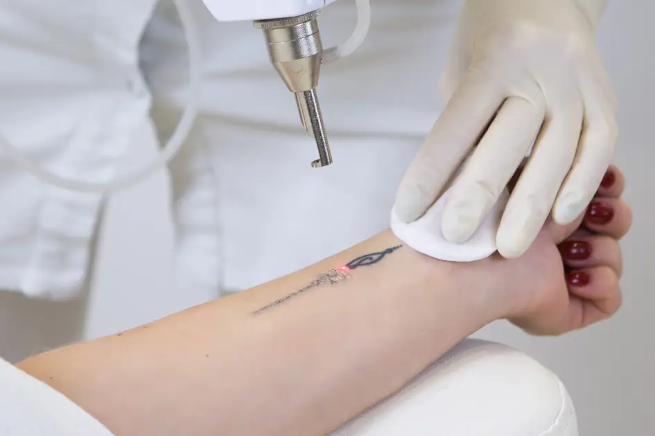 How Many Tattoo Removal Sessions Do You Need? Factors That Affect Results